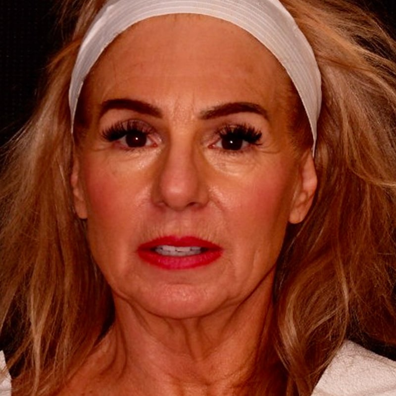 Facelift Before & After Image