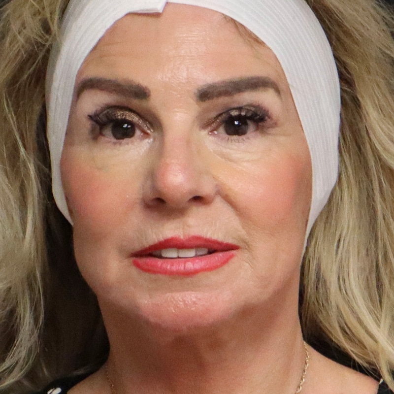 Facelift Before & After Image