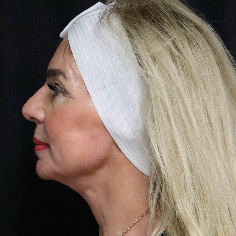 Facelift Before & After Image