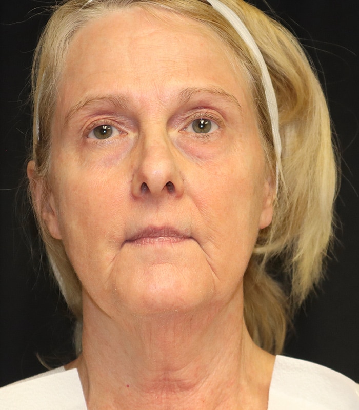 Facelift Before & After Image