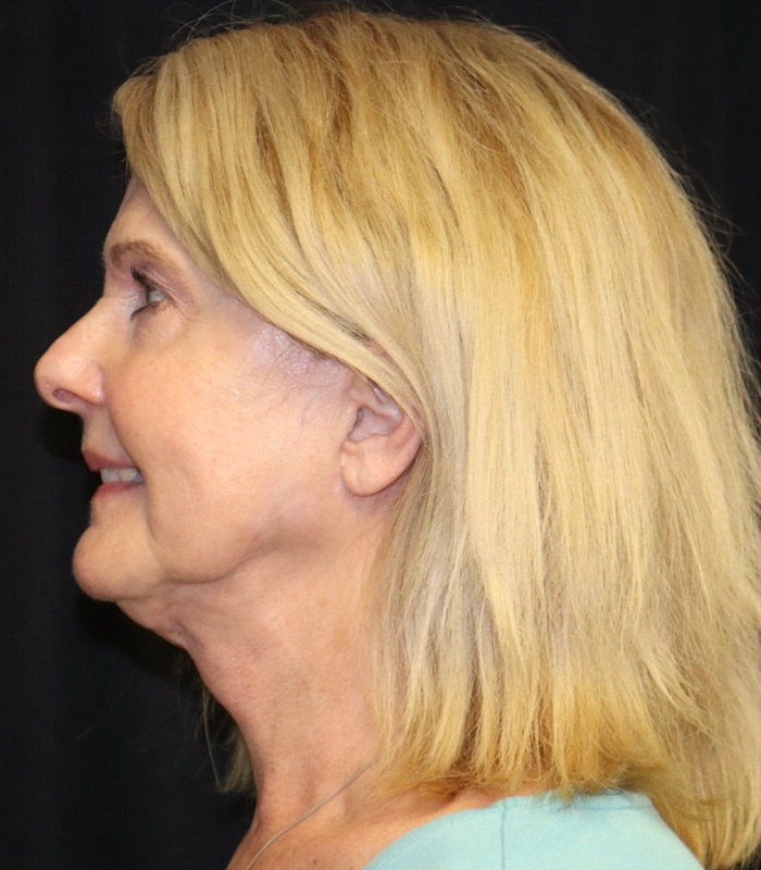 Facelift Before & After Image