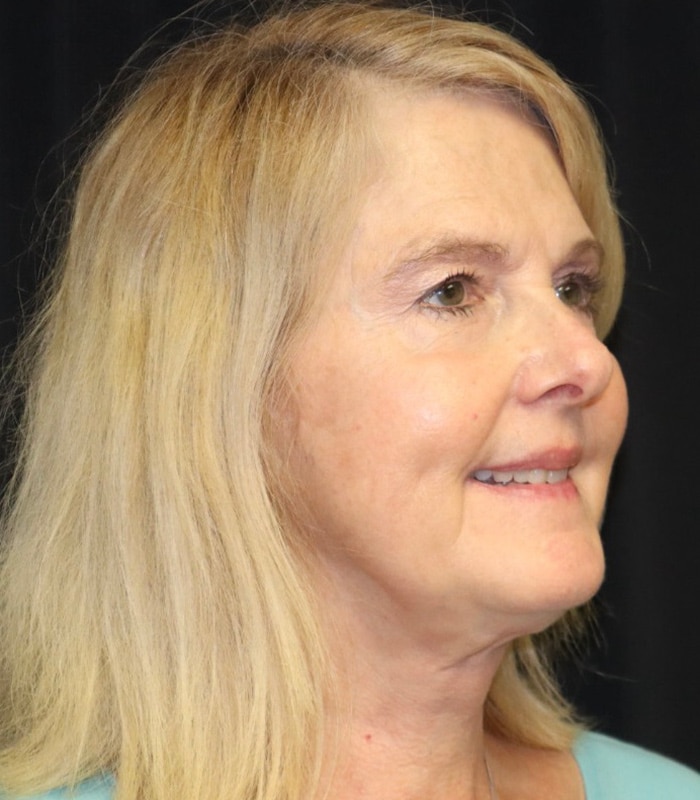 Facelift Before & After Image