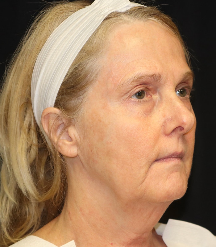 Facelift Before & After Image