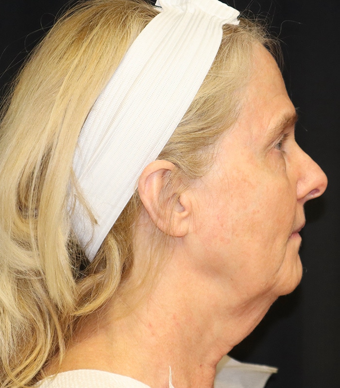 Facelift Before & After Image
