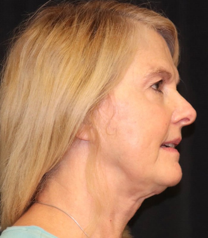 Facelift Before & After Image