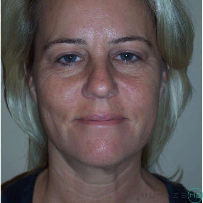 Facelift Before & After Image