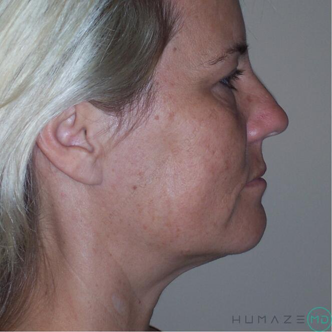 Facelift Before & After Image
