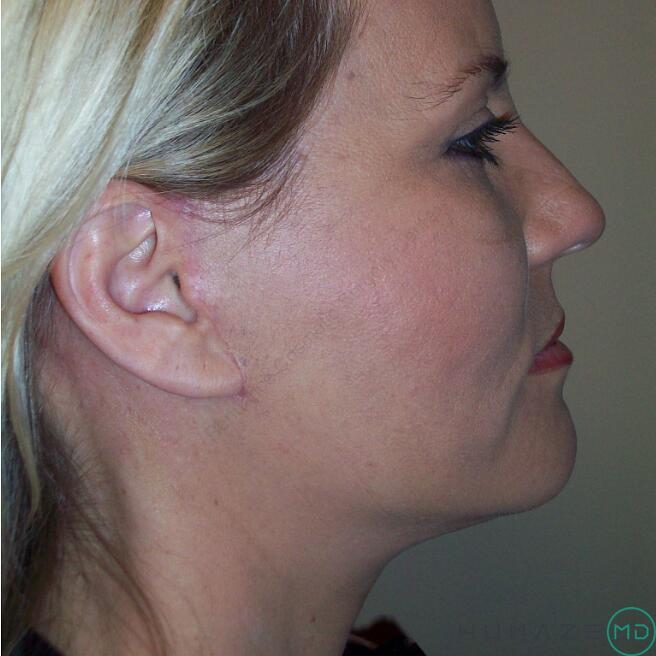 Facelift Before & After Image