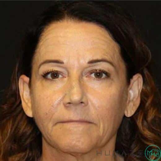 Facelift Before & After Image