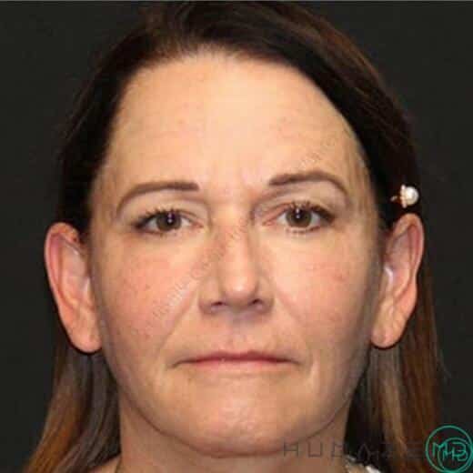 Facelift Before & After Image