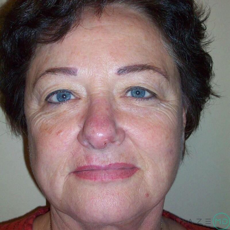 Facelift Before & After Image