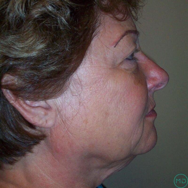 Facelift Before & After Image