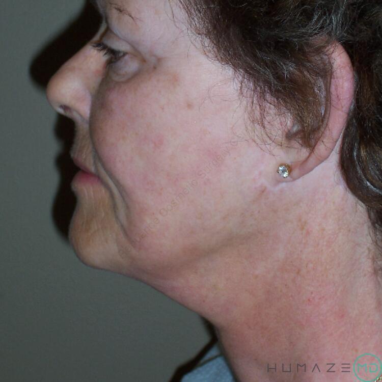 Facelift Before & After Image