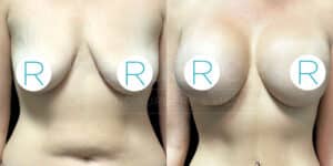 A side-by-side comparison of a female torso before and after breast augmentation surgery. The image on the left shows the torso with smaller, sagging breasts, while the image on the right shows the torso with larger, lifted breasts. Circular labels with the letter "R" cover the nipples in both images. The background is plain.