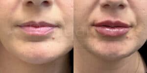 Close-up comparison images of a person's lips, showing before and after results of a cosmetic lip enhancement procedure. The left image shows their natural lips, while the right image shows fuller lips post-procedure.