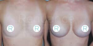 Comparison image showing the results of a breast augmentation procedure. The left side depicts the patient before surgery, and the right side shows the enhanced breast size and shape after the procedure. The image includes the branding of "Renuance Cosmetic Surgery Medspa".