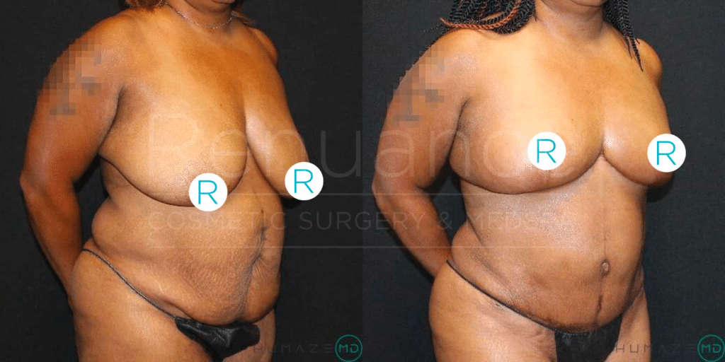 breast reduction patient before and after the procedure