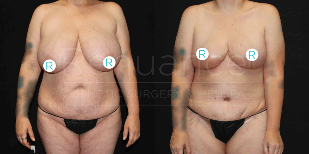 before and after of a breast reduction