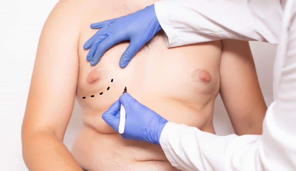 Gynecomastia Surgery blog