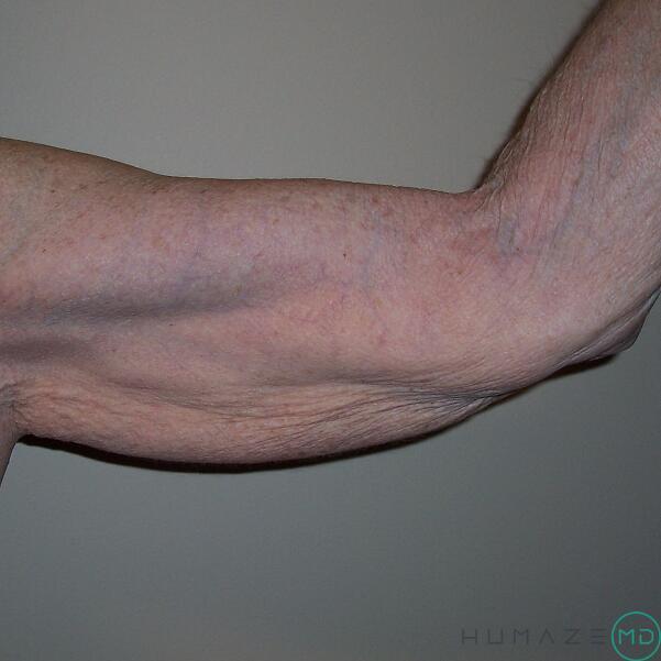 Arm Lift Before & After Image