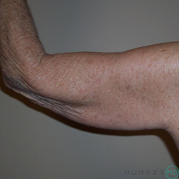 Arm Lift Before & After Image