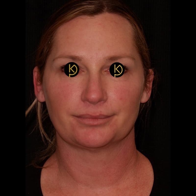 Liposuction Before & After Image