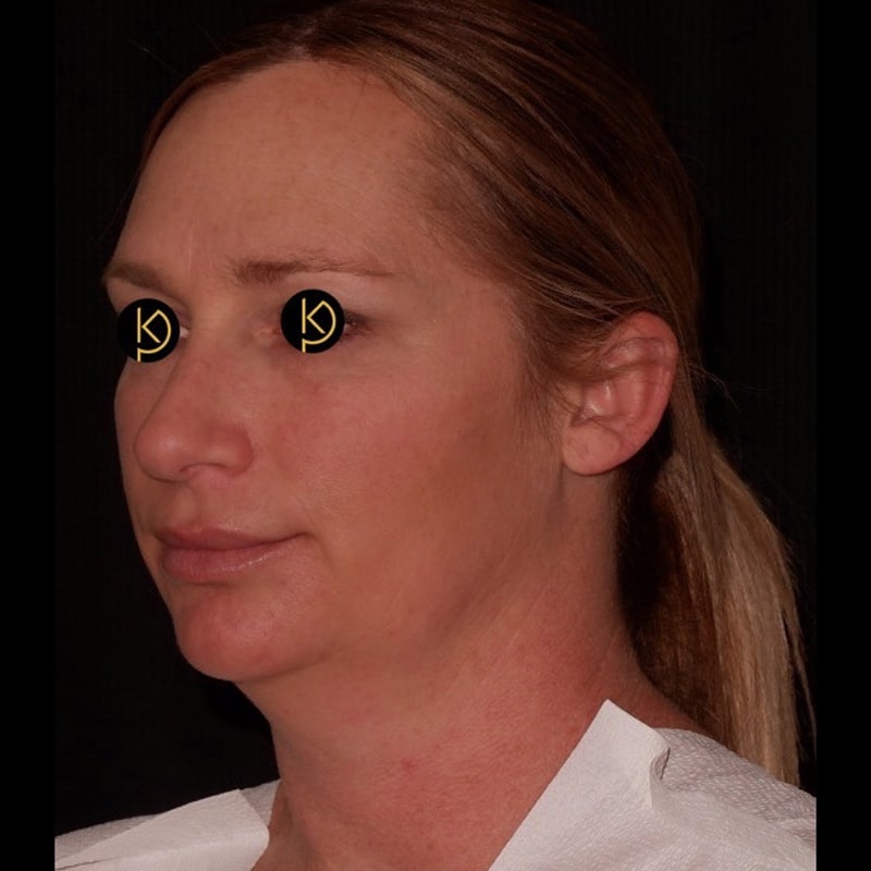 Liposuction Before & After Image