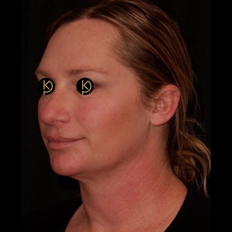 Liposuction Before & After Image