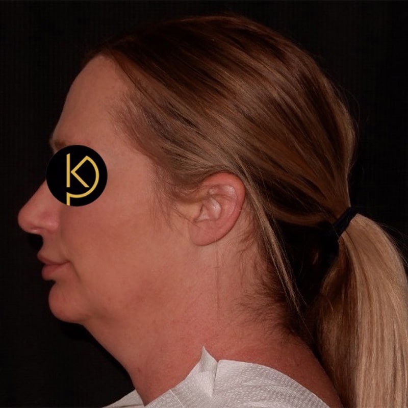 Liposuction Before & After Image