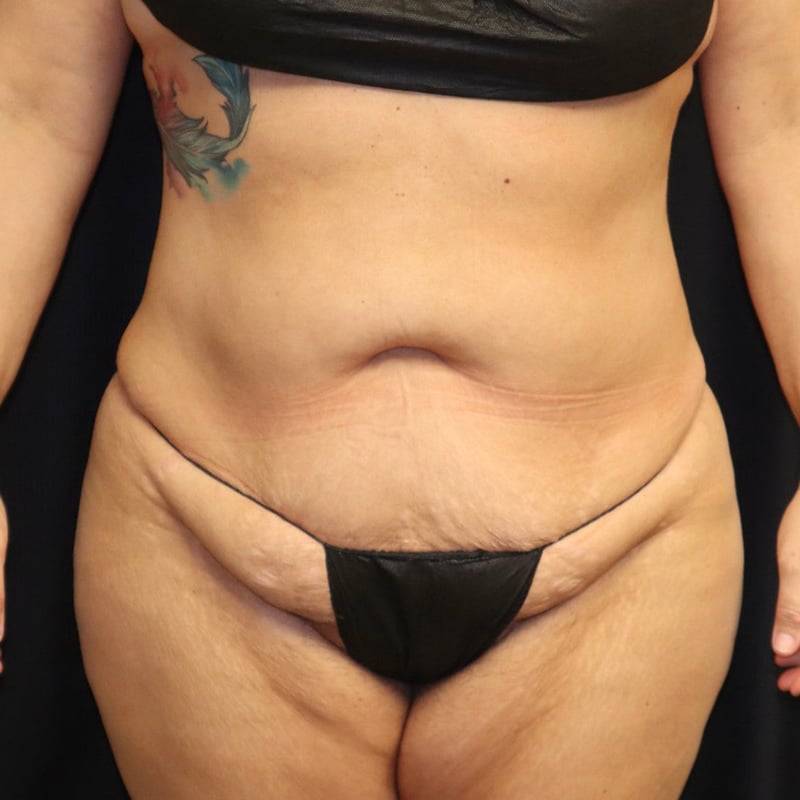 Liposuction Before & After Image
