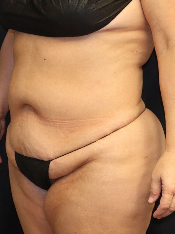 Liposuction Before & After Image