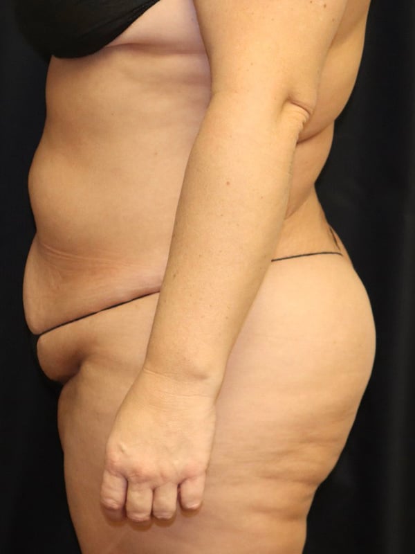 Liposuction Before & After Image