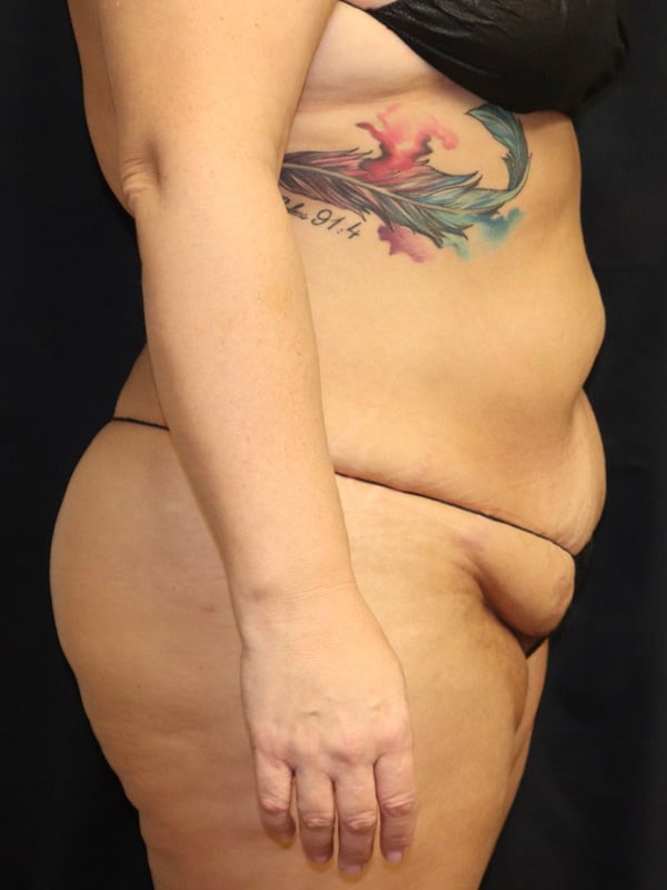 Liposuction Before & After Image