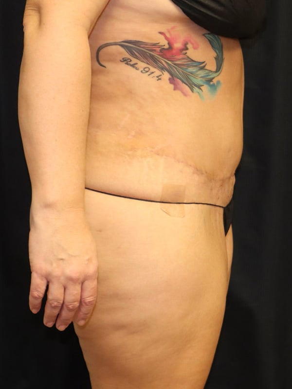 Liposuction Before & After Image