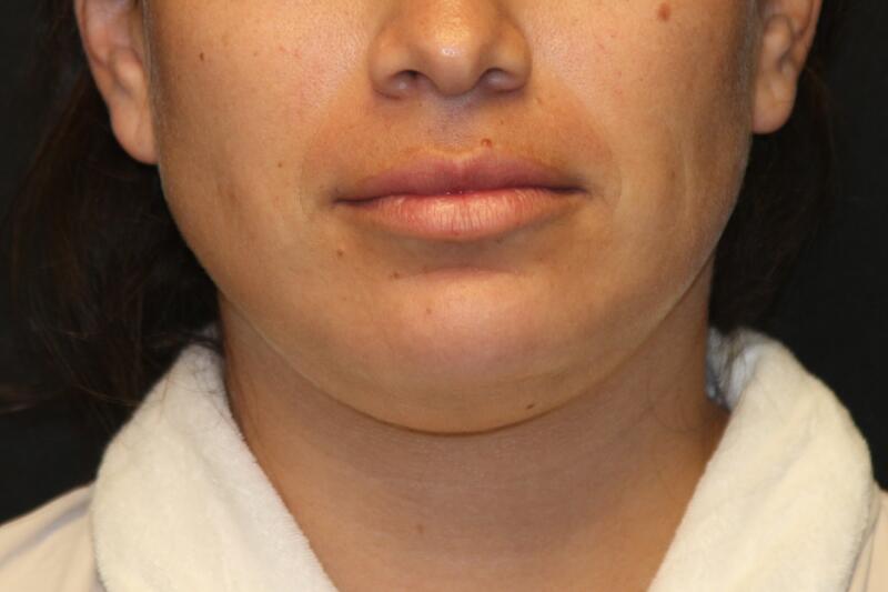 Liposuction Before & After Image