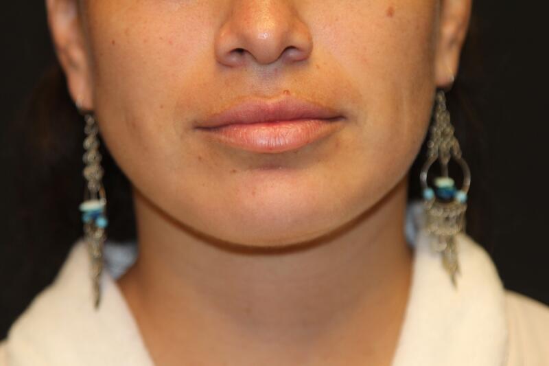 Liposuction Before & After Image