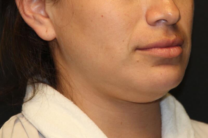 Liposuction Before & After Image