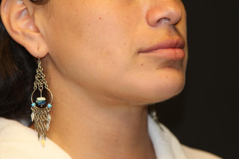 Liposuction Before & After Image