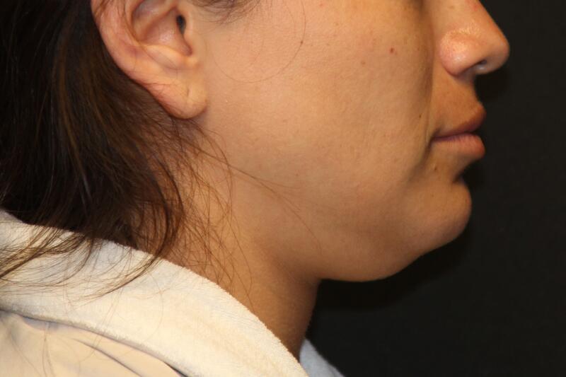 Liposuction Before & After Image