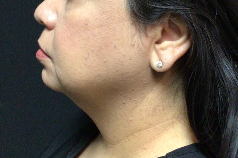 Liposuction Before & After Image