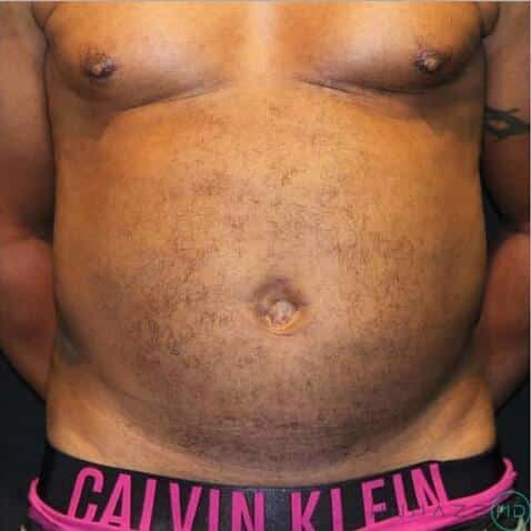 Liposuction Before & After Image