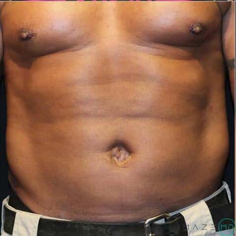 Liposuction Before & After Image