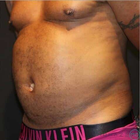 Liposuction Before & After Image