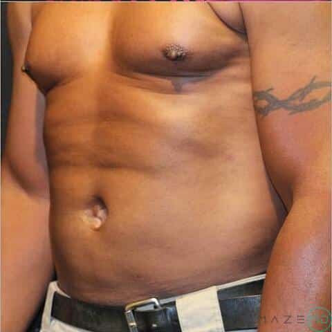 Liposuction Before & After Image