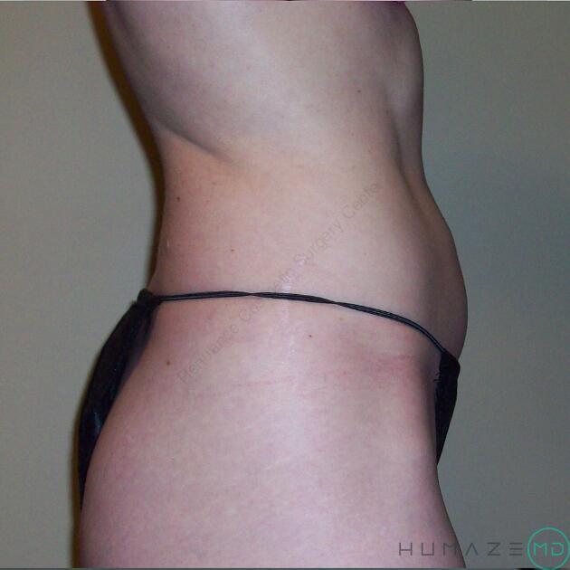 Liposuction Before & After Image