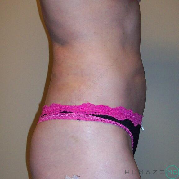 Liposuction Before & After Image