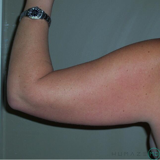 Liposuction Before & After Image