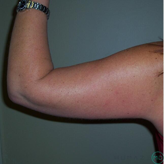 Liposuction Before & After Image