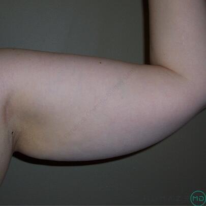 Liposuction Before & After Image