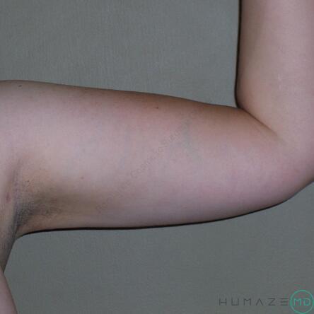 Liposuction Before & After Image